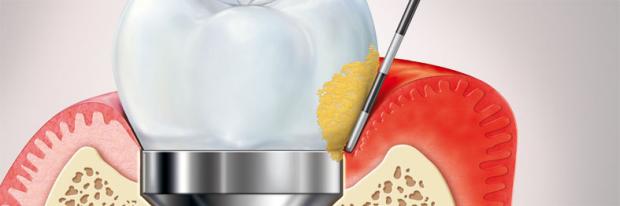 Treatment Algorithms for Peri-Implant Mucositis and Peri-Implantitis