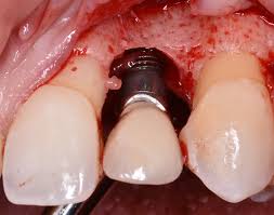 Prosthetic Design Factors That Prevent Peri-Implant Bone Loss